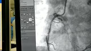 In stent restenosis ISR [upl. by Aneis574]