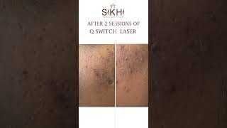 Treatment for Acne Scars  QSwitch Laser  Before amp After  Sikhi Skin Clinic pimpletreatment [upl. by Ylehsa85]