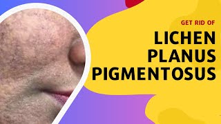 Get Rid of Lichen Planus Pigmentosus [upl. by Laniger630]