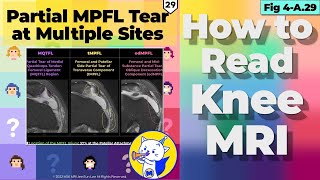 Fig 4A29 Partial MPFL Tear at Multiple Sites [upl. by Strepphon]