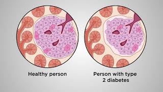 Beyond glucose A betacell centric approach to prevent type 2 diabetes [upl. by Rosenkranz782]