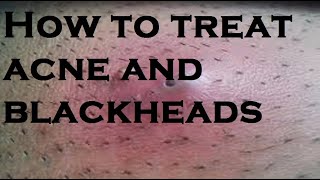 How to treat acne and blackheads [upl. by Nav]