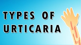 Urticaria Symptoms Treatment and Causes [upl. by Auria713]