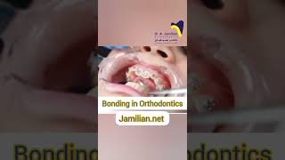 Steps of Bonding in Orthodontics [upl. by Suraved]