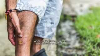 The Mark of Neglect Cutaneous Leishmaniasis [upl. by Nnyled]