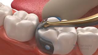 Palodent V3 EZ Coat  Dentsply Sirona [upl. by Leiser]