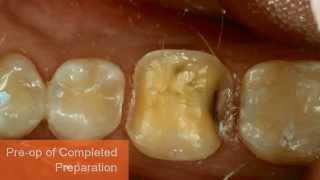 Immediate Dentin Sealing Technique [upl. by Marvella]