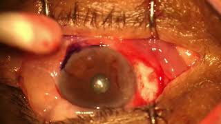 pterygium c grafting [upl. by Eednar]