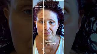 PDO Thread Lift Before and After Nonsurgical Facelift PCH MedSpa Newport Beach [upl. by Atiuqiram]