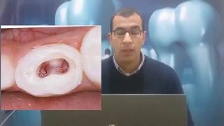 البيدو pulpotomy ولا pulpectomy [upl. by Oneal]