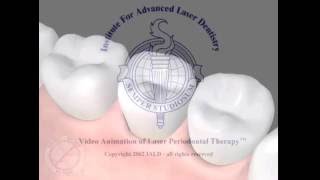 LANAP Laser Assisted New Attachment Procedure Laser Periodontal Treatment Laser Gum Treatment [upl. by Chesney]