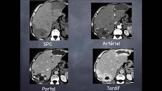 Tumeurs du foie  Bénignes  3 Hémangiome hépatique [upl. by Glennis61]