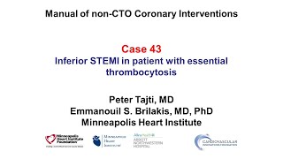 Case 43 PCI Manual  STEMI in a patient with essential thrombocytosis [upl. by Ahsetal]