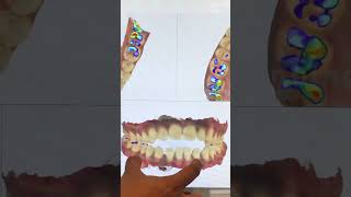 Invisalign Time Lapse  Invisalign Braces  Invisalign Before After invisalignsmile clearaligner [upl. by Swanhilda]