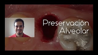 Preservación Alveolar  Dr Edwin Ruales Carrera [upl. by Renato]