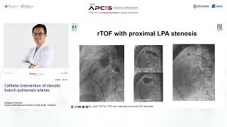 Catheter intervention of stenotic branch pulmonary arteries [upl. by Ila424]