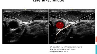 Stellate Ganglion Block [upl. by Zoes452]