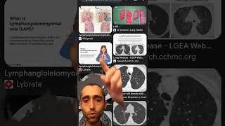 Radiology and pulmonology  Lymphangioleiomyomatosis LAM [upl. by Llednahs]