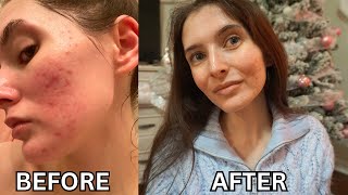 Treating my acne with Spironolactone  2 MONTHS  with pictures [upl. by Gennifer]