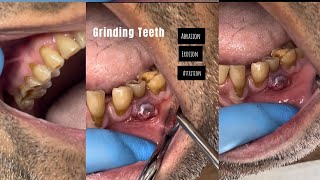 GRINDING TEETH  AbrasionErosion Attrition [upl. by Nisay679]