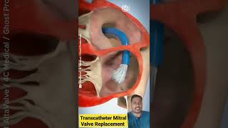 Transcatheter Mitral Valve Replacement 3D animated video shorts viralvideo 3d [upl. by Melan]