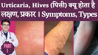 Skin Rash Urticaria Hives Causes Types Symptoms I Urticaria Hives Kyu Hota hai lakshan kya hai [upl. by Yacov]