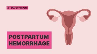 Postpartum hemorrhage Early detection can save lives [upl. by Nylodnewg]