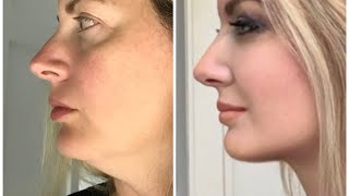 Before and after facelift and neck lift [upl. by Rosane]