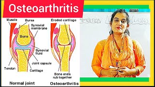 Osteoarthritis  Causes Symptoms Treatment Diagnosis Medical Surgical amp Nursing Management [upl. by Luba]