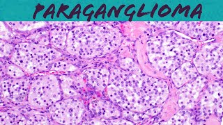 Paraganglioma carotid body tumor amp Pheochromocytoma explained in 5 minutes pathology USMLE [upl. by Ardnalak558]