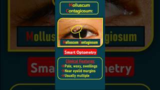 Molluscum Contagiosumoptometrist optometry optometrists eyediseases eyedisorder eyeliddiseases [upl. by Ahnavas]