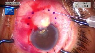 No Touch Technique Conjunctival Squamous Cell Carcinoma Resection [upl. by Anaeda]