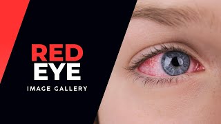 Red Eye Image Gallery [upl. by Allimak750]