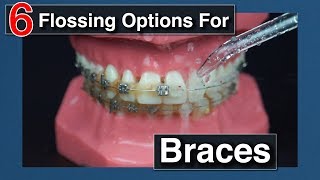 How to Floss with Braces [upl. by Ardnac]