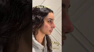 Scarless Facelift and Revision Rhinoplasty by DrTAS [upl. by Gran]