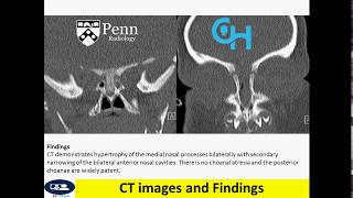 Congenital nasal pyriform aperture stenosis Newborn with respiratory distress [upl. by Ayr]