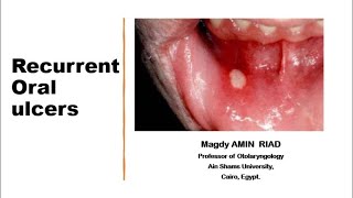 II Recurrent Oral Ulcers [upl. by Adleme]