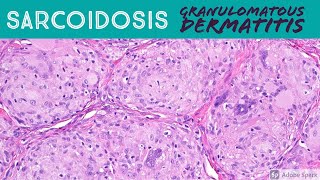 Sarcoidosis amp Granulomatous Dermatitis Pattern  Inflammatory Dermatopathology Basics [upl. by Amek760]