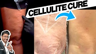 Want to Get Rid of Cellulite Youve Got to Try Aveli [upl. by Cnut]