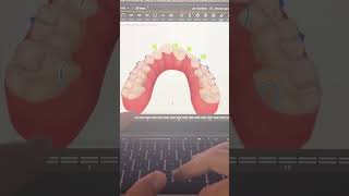 TIP 296  SKELETAL EXPANDER AND ALIGNERS [upl. by Haneehs]