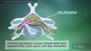 Cervical Spondylosis Definition [upl. by Welton]