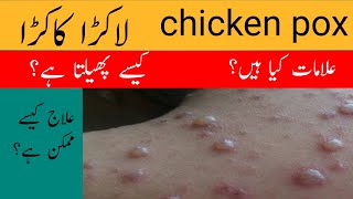 What is Chickenpox  What are Causes Signs Diagnosis and Treatment of Chicken pox in UrduHindi [upl. by Griz841]