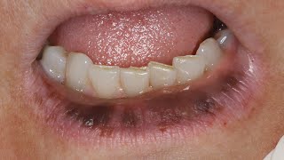 Bizarre Lip Pigmentation Case Dr Nemeths Successful Treatment Revealed [upl. by Anomahs]