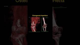 Osteogenesis Imperfecta [upl. by Mcclees]