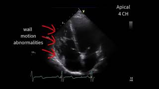 A special cardiomyopathy [upl. by Rett11]