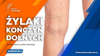 Żylaki kończyn dolnych  metody leczenia [upl. by Sira]