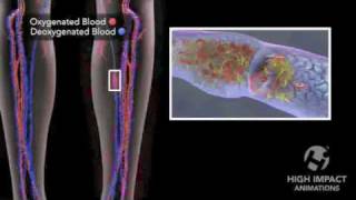 Deep Vein Thrombosis [upl. by Lightfoot]