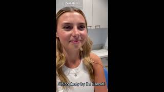 Ultrasonic Piezo Rhinoplasty by Dr Zarrabi [upl. by Icken382]