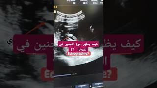 كيف يظهر نوع الجنين في السونار échographie؟؟ حمل حامل baby [upl. by Werbel]