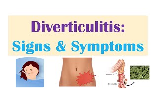 Diverticulitis Signs amp Symptoms And Why They Occur [upl. by Kacy140]